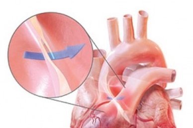 Vom Herz direkt ins Hirn: PFO als Risikofaktor bei Schlaganfall