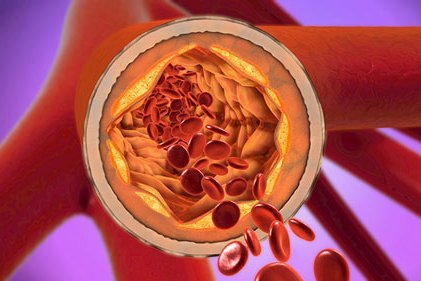 Warum die Cholesterinsenkung mit Statinen und Co. So wichtig ist