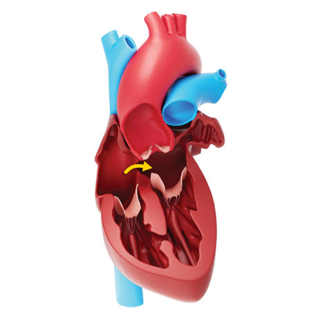 PFO bedeutet persistierendes Foramen ovale