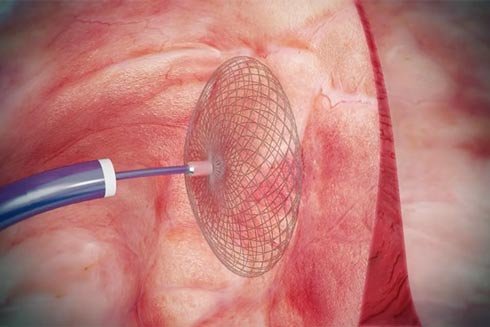 Schirmchen zum Schutz vor Schlaganfall