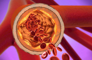 Runter mit den Blutfetten: Warum die Cholesterinsenkung mit Statinen und Co. so wichtig ist
